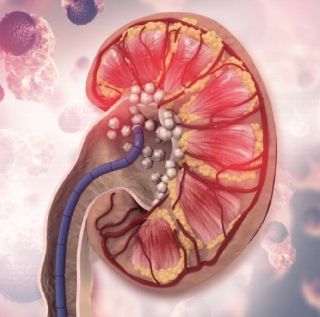 Cáncer de Riñón