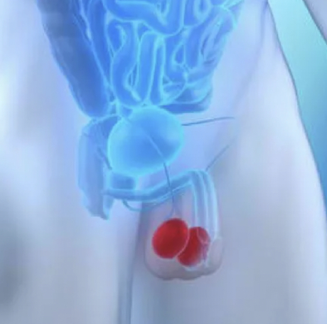 Cáncer Testicular