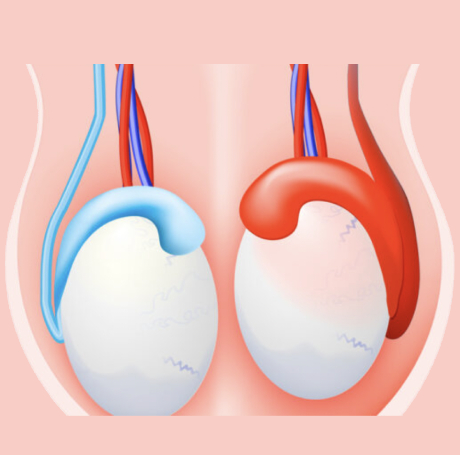 Epididimitis