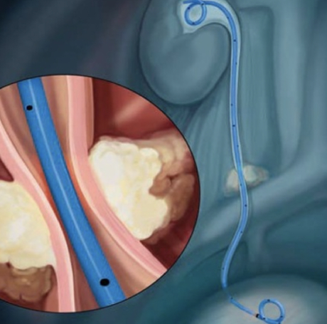 Estenosis Ureteral