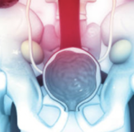 Estenosis Ureteral