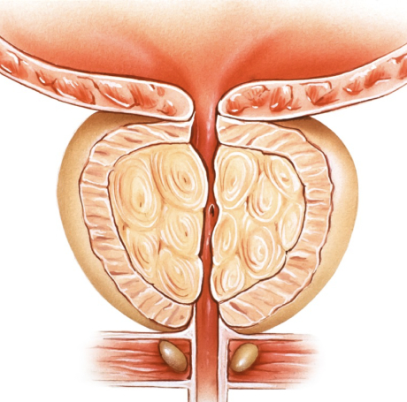 Prostatitis
