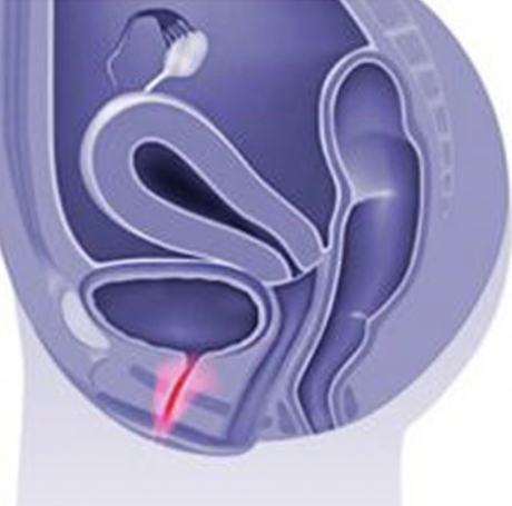 Uretritis