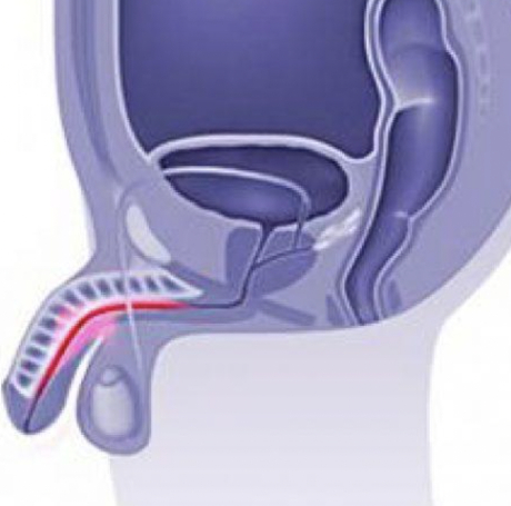Uretritis